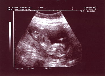 The 16 wks ultrasono report